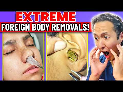 Doctor Reacts to EXTREME & SATISFYING Foreign Body Removals!