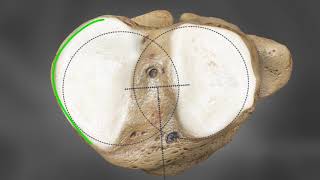 Custom Total Knee Replacement/Resurfacing by Conformis