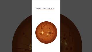 Diabetic Retinopathy #medicine #medicalstudent #ophthalmology #optometrystudent #endocrinology