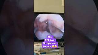 #acl #ligamentinjury #aclsurgeryrecovery #naveensharma #aclprocedure #kneeinjury #aosih