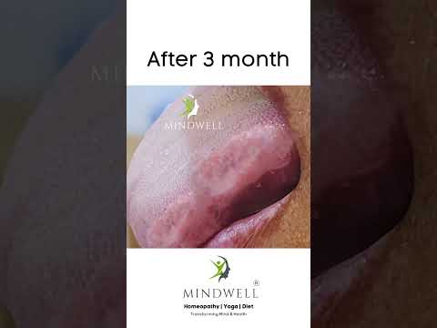 Linus planus :Wonderful results at Mindwell. www.mindwell.co.in #homeopathy #homeoclinic #skincare