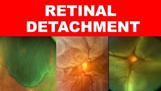 Retinal Detachment| Types, Risk Factors, Pathophysiology, Symptoms and Signs