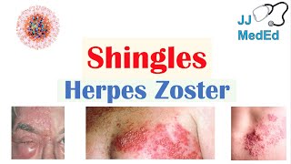 Shingles (Herpes Zoster): Pathophysiology, Risk Factors, Phases of Infection, Symptoms, Treatment