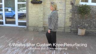 Custom Knee resurfacing, The Conformis iDuo 3, showing 3 patients recovery