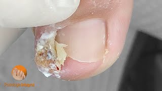 I proceed very carefully to decompress the area and remove the spicule | Onychocryptosis + granuloma