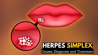 Herpes Simplex, Causes, Signs and Symptoms, Diagnosis and Treatment.