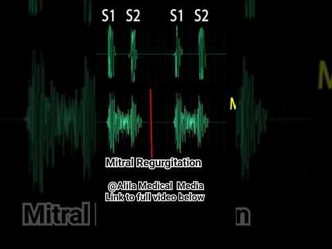 Heart Murmurs: Mitral Valve Regurgitation #heartmurmurs  #medicalanimation