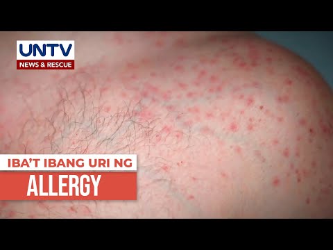 Mga uri ng allergy ayon sa eksperto