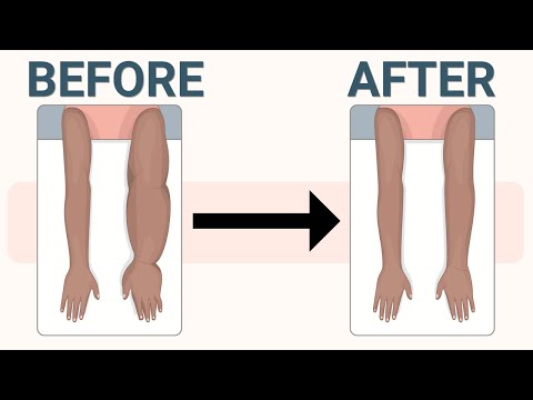 Treatment for Arm Lymphedema and Swelling after Cancer Surgery