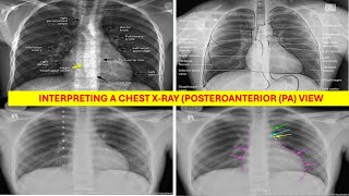 How to Reading and interpreting a chest X-ray (posteroanterior (PA) view) systematically ?