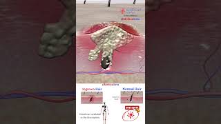 Ingrown Hair ⨖ Laser Treatment ⨕ Medical Arts 3D Animation