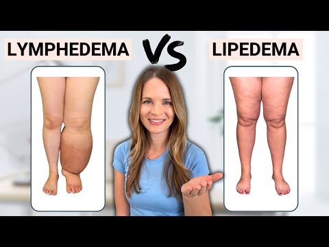 Is it Lymphedema or Lipedema?