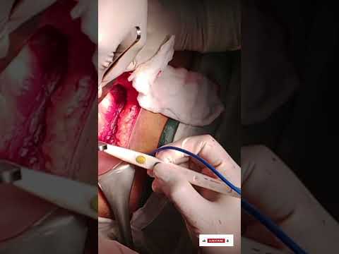 Open Nephrectomy operation #Open Surgery #Nephrectomy  open operation