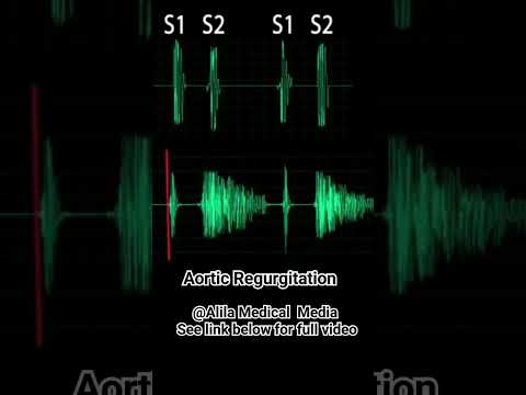 Heart Murmurs: Aortic Regurgitation #heartsounds #heartmurmurs #medicalanimation