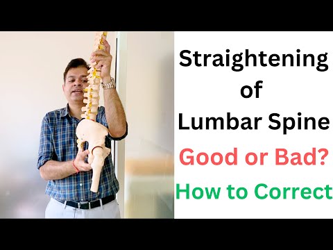 Straightening of Lumbar Spine, Loss Of Lumbar Lordosis, Spine Straightening Exercises, Must Watch