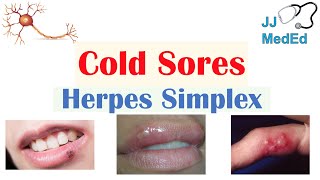 Cold Sores | Oral Herpes | Causes, Signs & Symptoms, Treatment