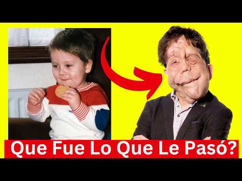 La Triste Historia de Adam Pearson | Que fue Lo que LE dejó el Rostro Deforme