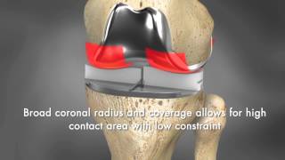 Custom Total Knee Replacement/Resurfacing by Conformis.