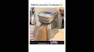 Belly fat removal by cryolipolysis #bellyfat #cryolipolysis #bellyfatloss #fatremoval #fatloss #fat