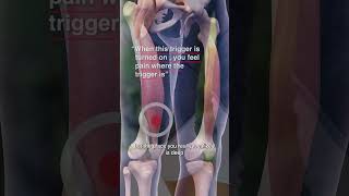 Are Vastus Medialis Trigger Points Causing Your Knee Pain?