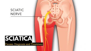 Sciatica, Causes, Signs and Symptoms, Diagnosis and Treatment