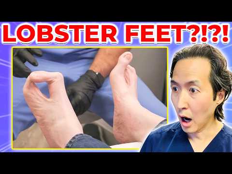 His Hands and Feet Resemble LOBSTER CLAWS?!?! Doctor Reacts to My Feet Are Killing Me!