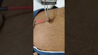 skin tag removal (painless)#skincare #skintags #cosmetics